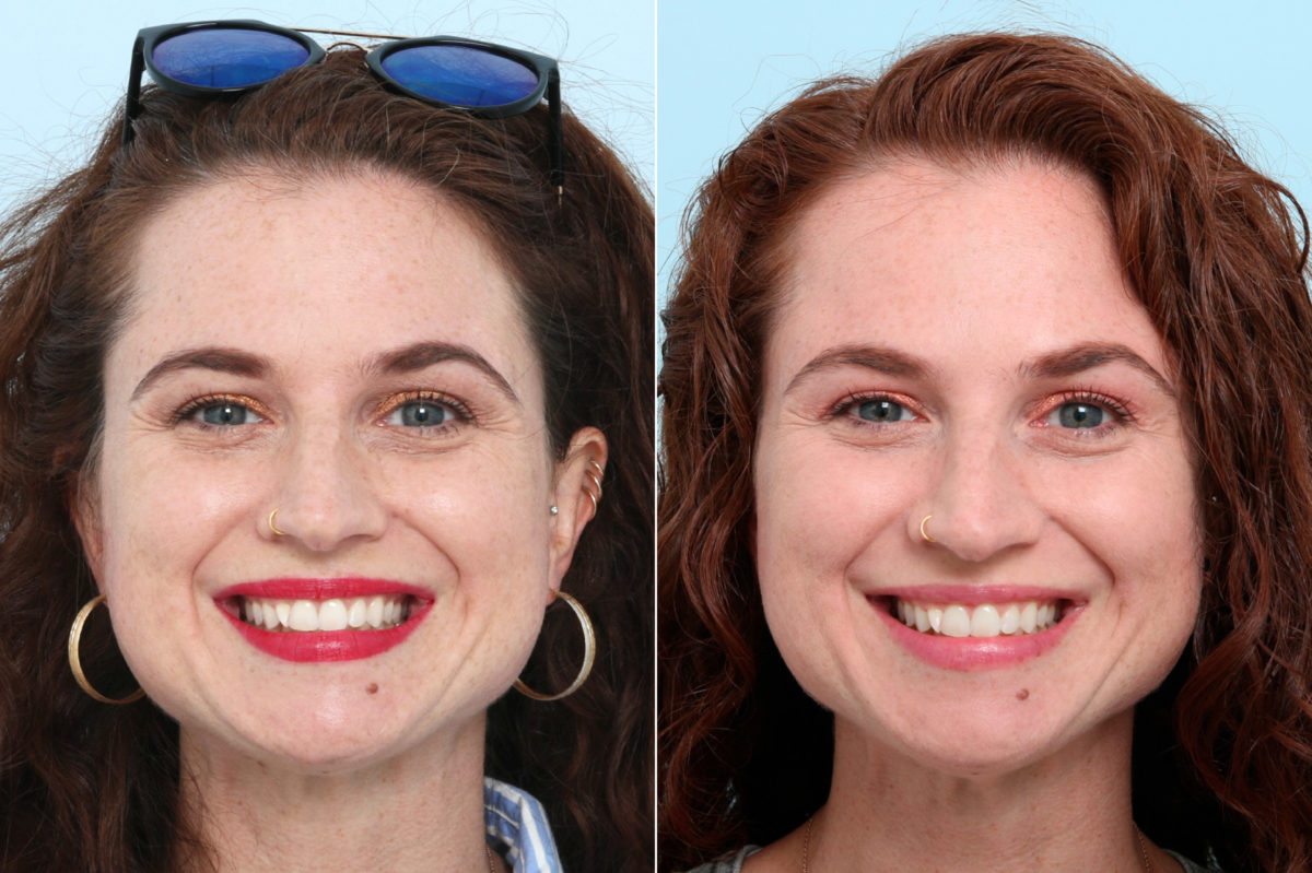 Botox® Cosmetic Before and After Photos in Houston, TX, Patient 10367