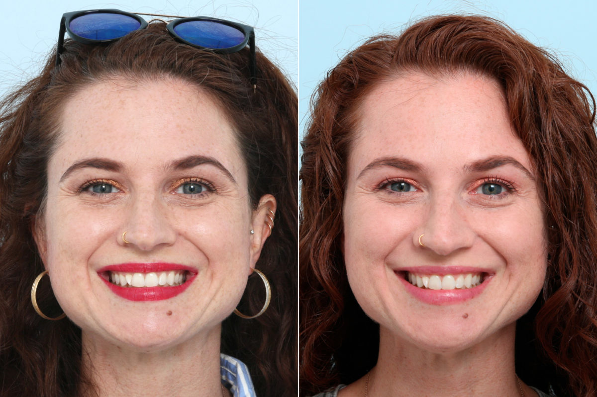 Botox® Cosmetic & Xeomin Before and After Photos in Houston, TX, Patient 10367