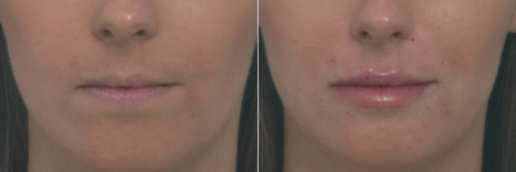 Lip Enhancement Before and After Photos in Houston, TX, Patient 10478