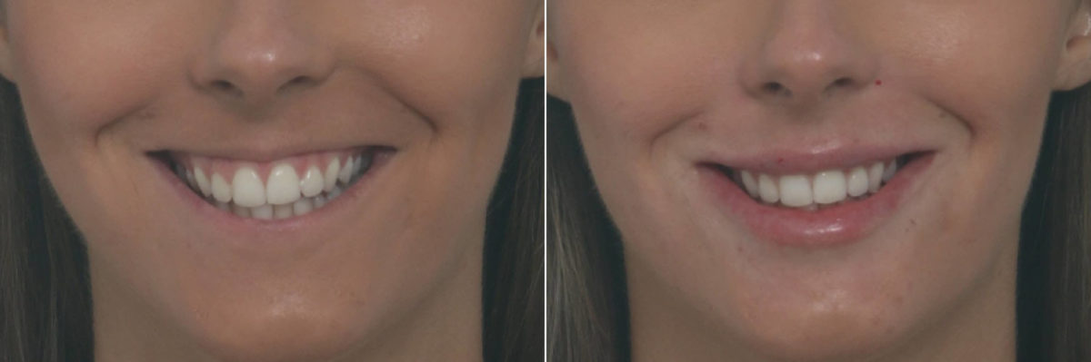 Lip Enhancement Before and After Photos in Houston, TX, Patient 10478