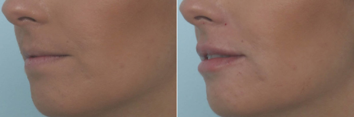 Lip Enhancement Before and After Photos in Houston, TX, Patient 10478