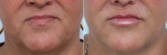 Lip Enhancement Before and After Photos in Houston, TX, Patient 8077