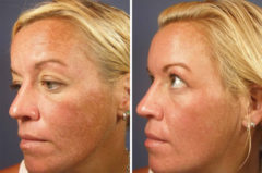 Chemical Peels Before and After Photos in Houston, TX, Patient 8351