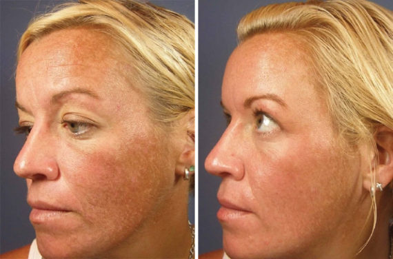 Chemical Peels Before and After Photos in Houston, TX