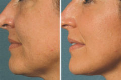 Chemical Peels Before and After Photos in Houston, TX, Patient 8357