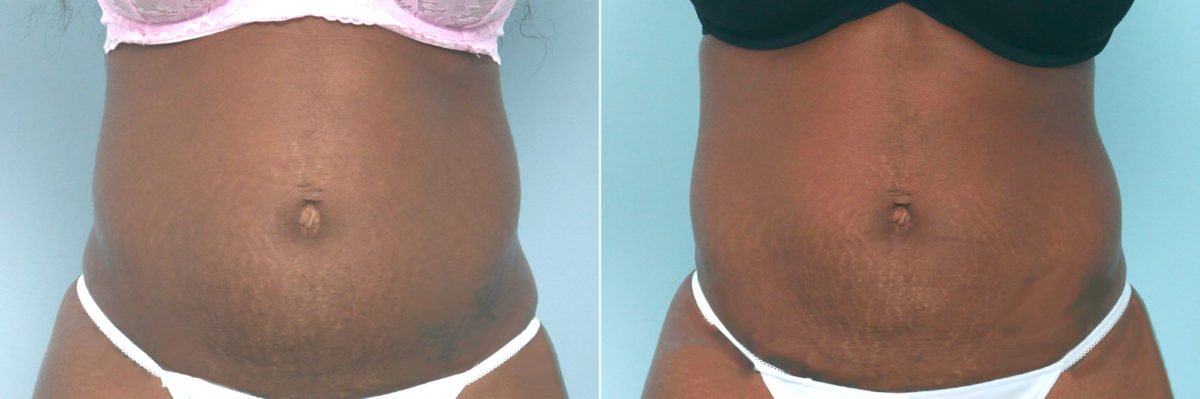 CoolSculpting Before and After Photos in Houston, TX, Patient 10539