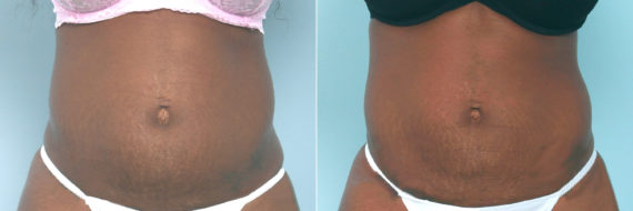 CoolSculpting Before and After Photos in Houston, TX, Patient 10539
