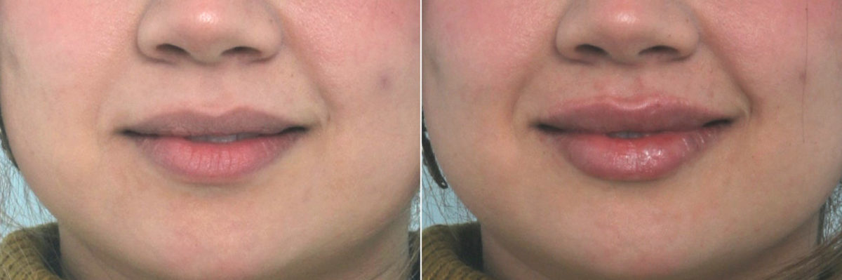 Lip Enhancement Before and After Photos in Houston, TX, Patient 10684