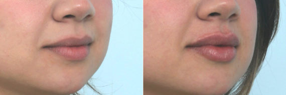 Lip Enhancement Before and After Photos in Houston, TX, Patient 10684