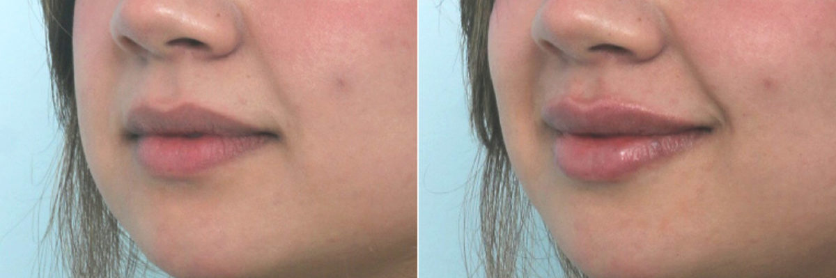 Lip Enhancement Before and After Photos in Houston, TX, Patient 10684