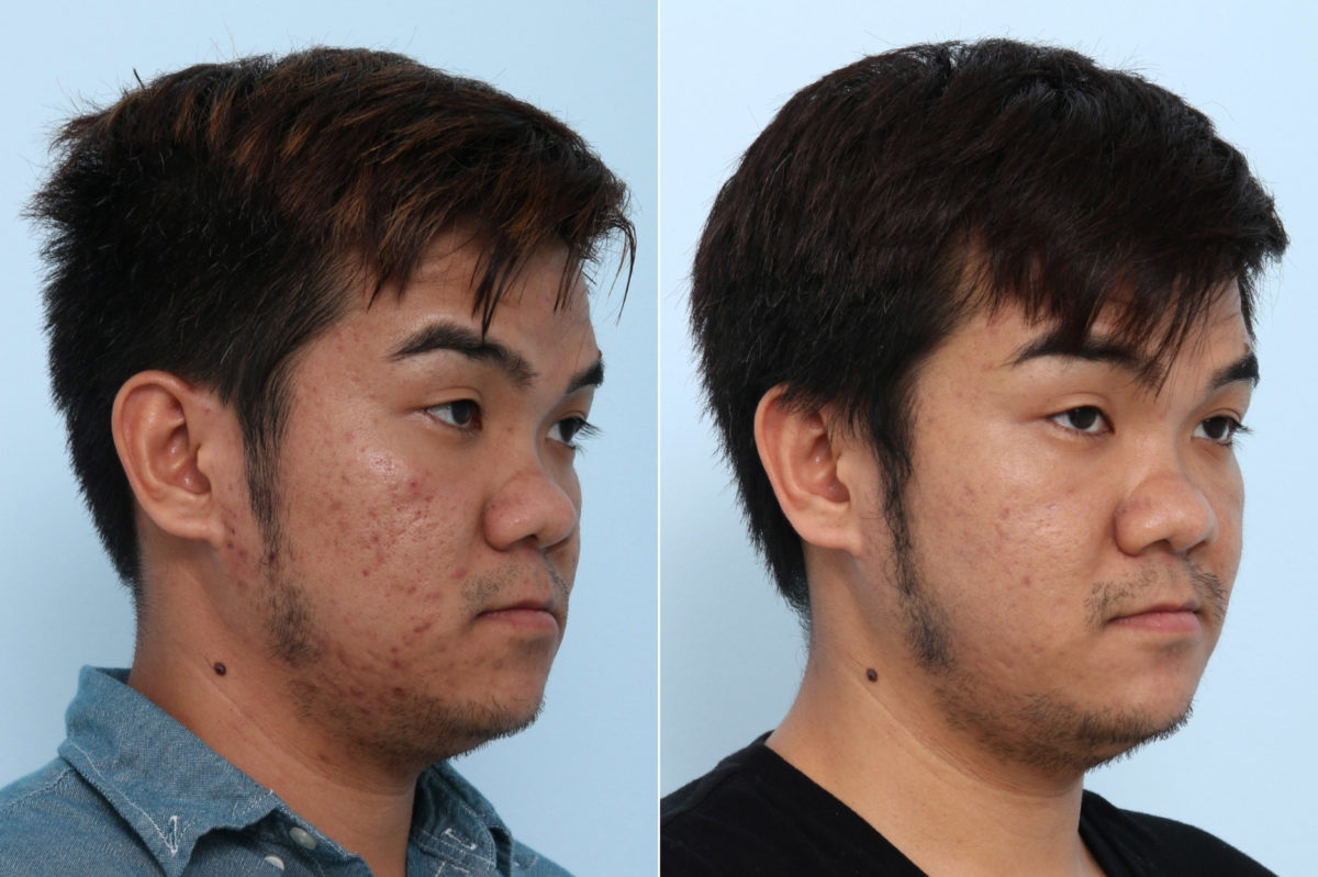 Fraxel Laser Before and After Photos in Houston, TX, Patient 10754