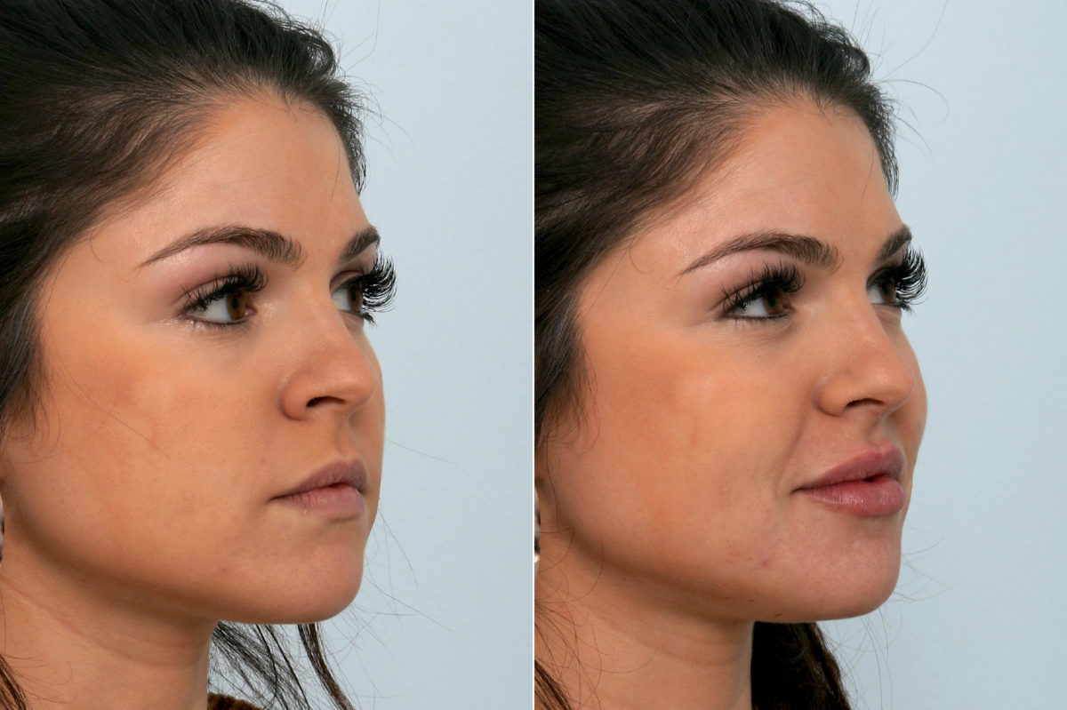 Juvederm Injectable Gel Before and After Photos in Houston, TX, Patient 10755