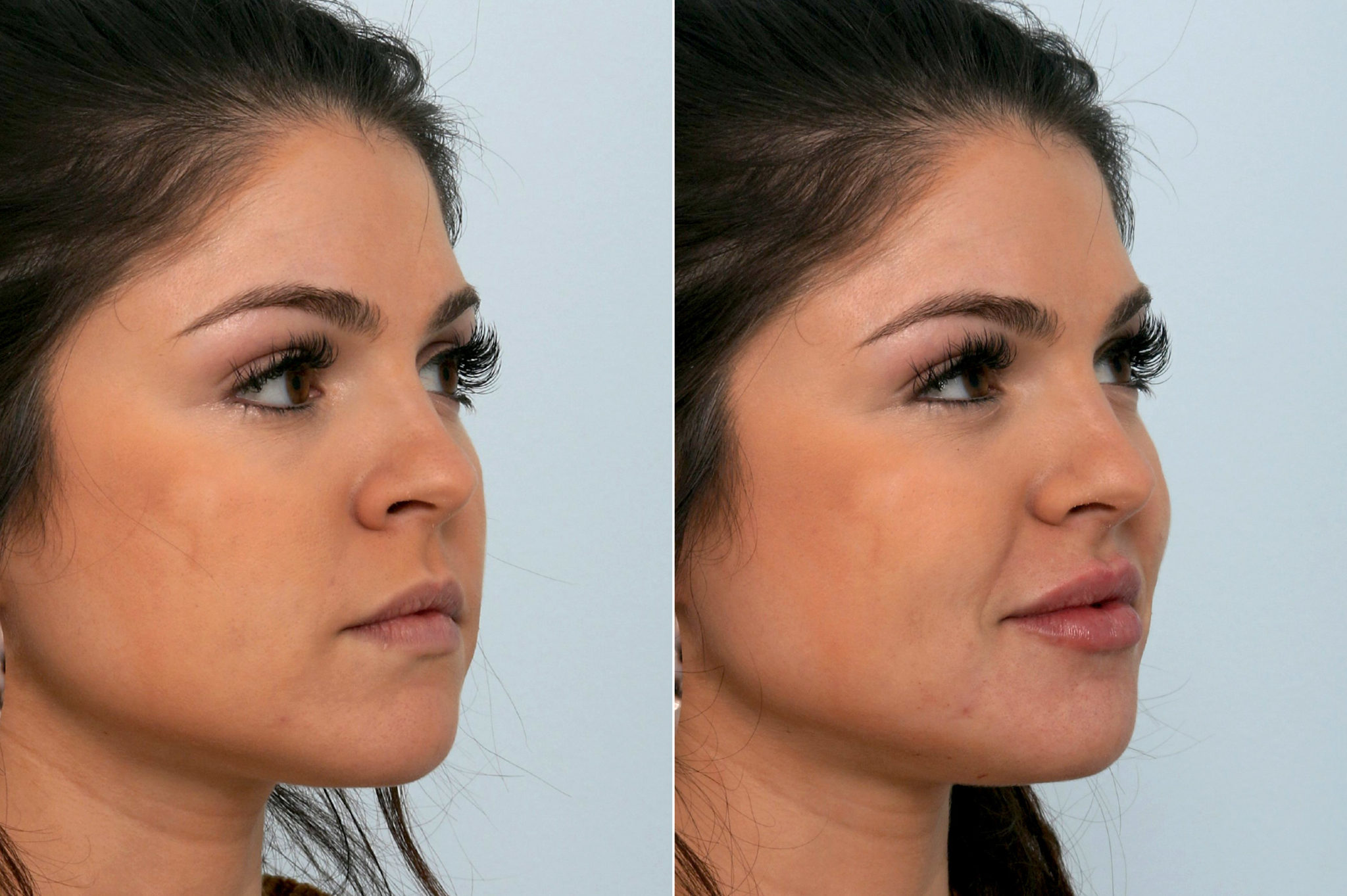 Juvederm Injectable Gel Before and After photo gallery