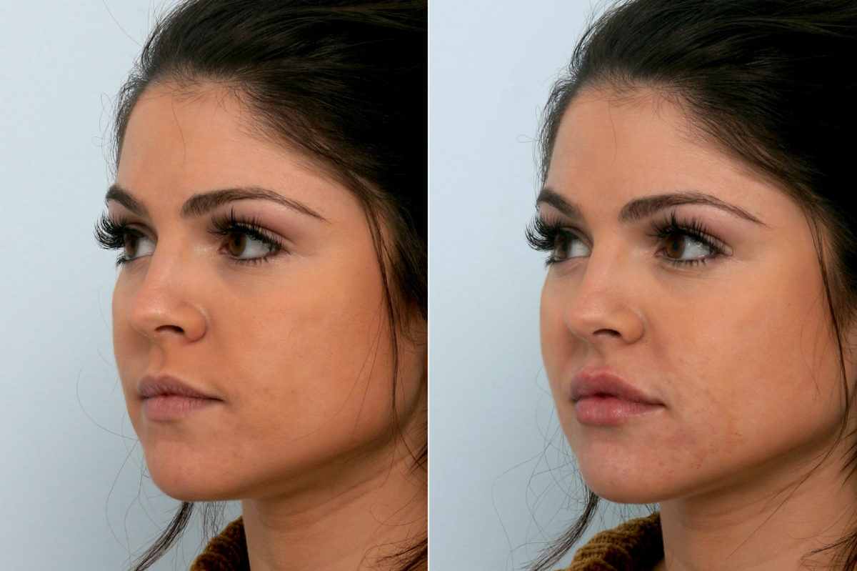 Juvederm Injectable Gel Before and After Photos in Houston, TX, Patient 10755