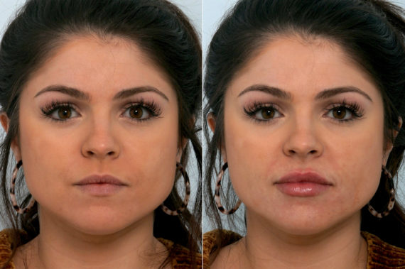 Juvederm Injectable Gel Before and After Photos in Houston, TX, Patient 10755