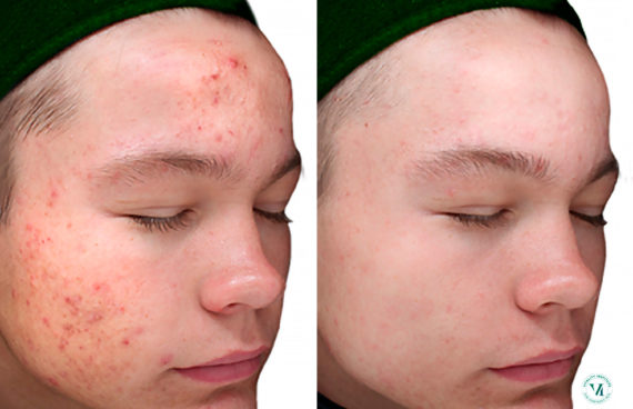 Chemical Peels Before and After Photos in Houston, TX, Patient 10780