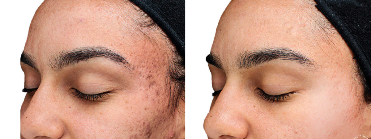 Chemical Peels Before and After Photos in Houston, TX, Patient 10781