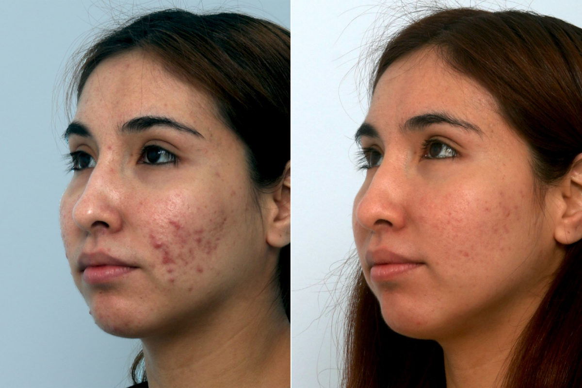 Fraxel Laser Before and After Photos in Houston, TX, Patient 10943