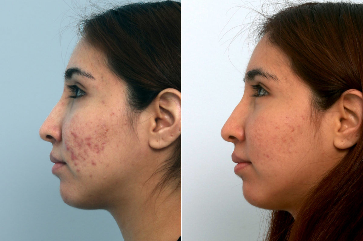 Fraxel Laser Before and After Photos in Houston, TX, Patient 10943