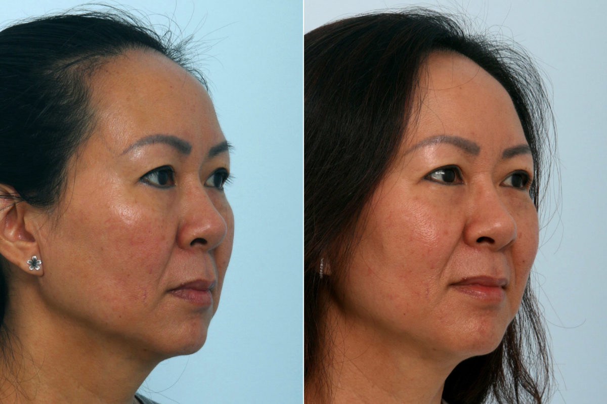 Fraxel Laser Before and After Photos in Houston, TX, Patient 10961