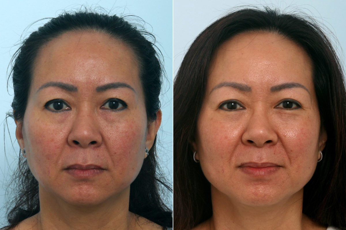 Fraxel Laser Before and After Photos in Houston, TX, Patient 10961