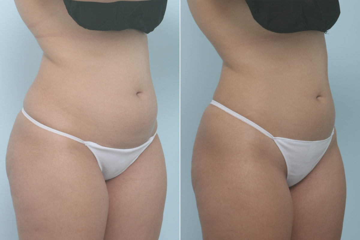 CoolSculpting Before and After Photos in Houston, TX, Patient 11357