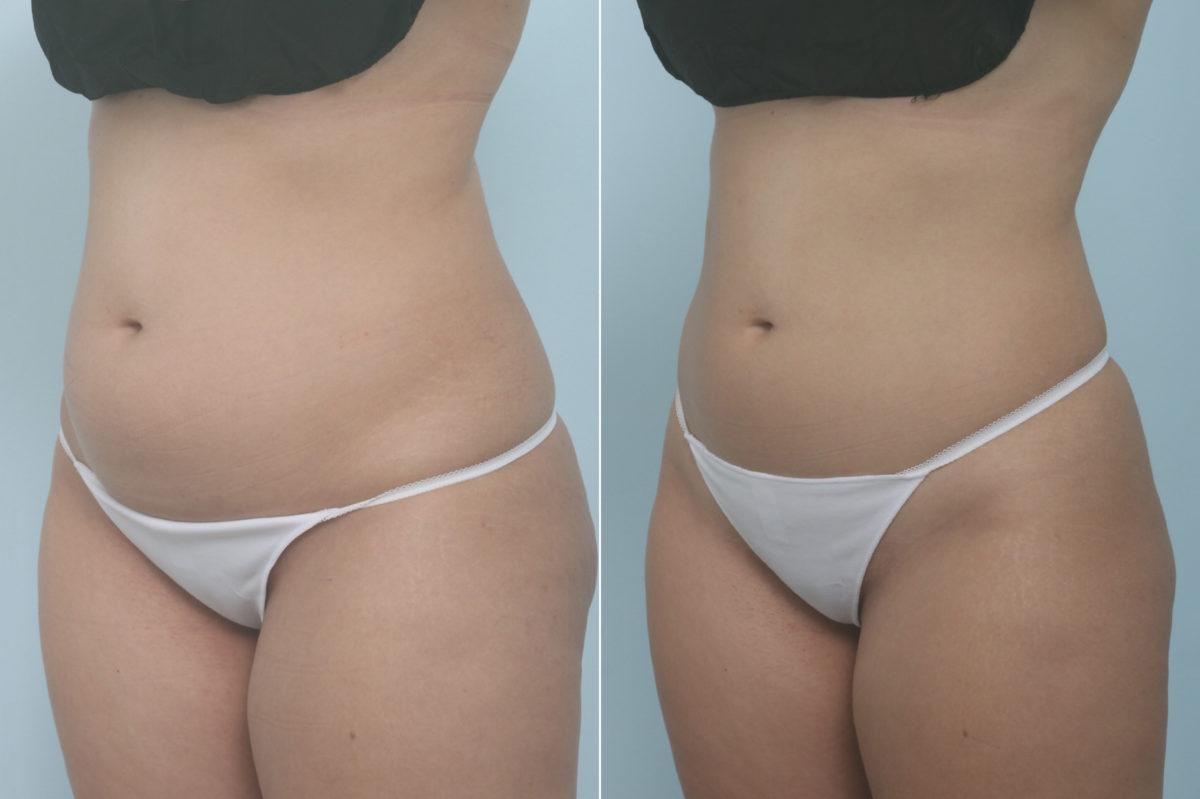 CoolSculpting Before and After Photos in Houston, TX, Patient 11357