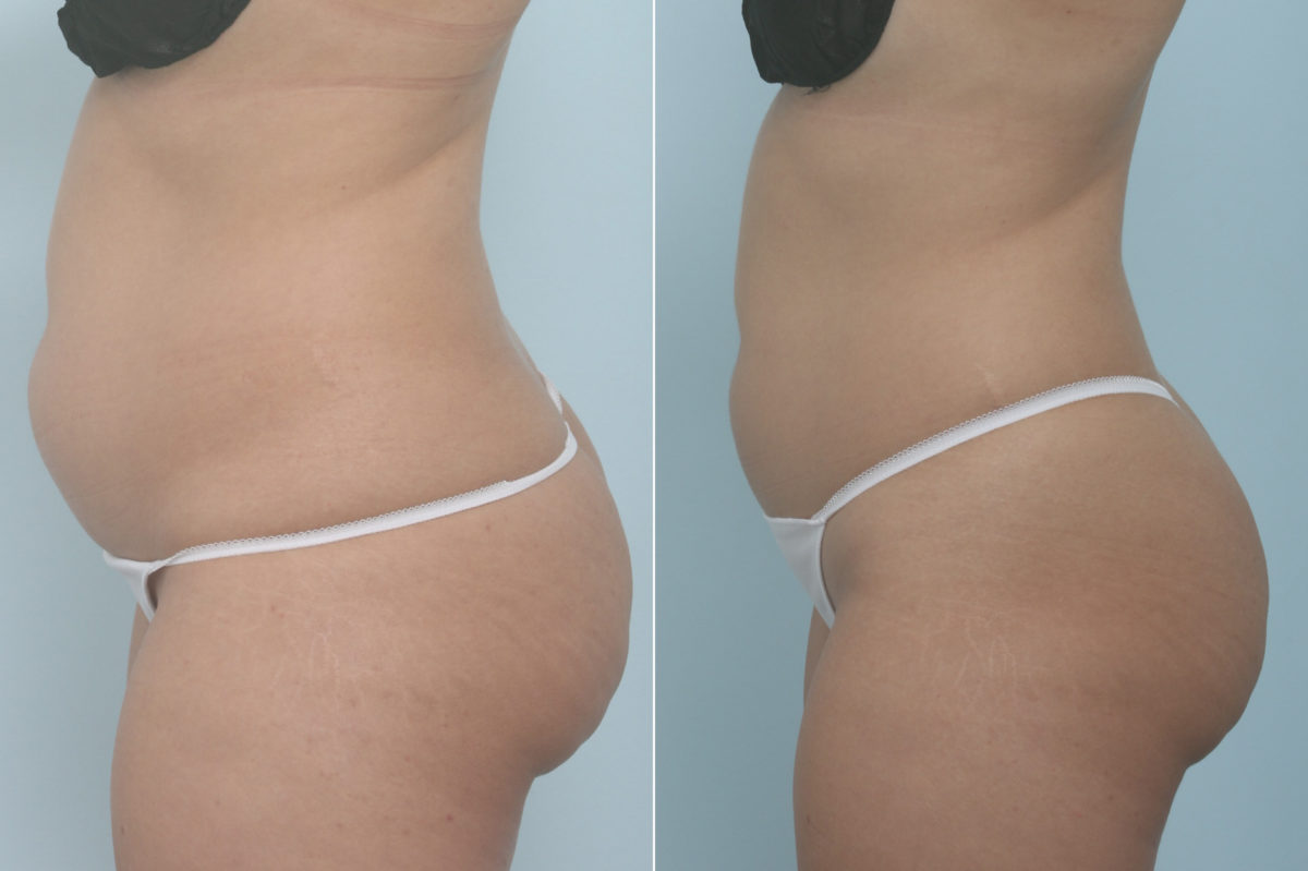 CoolSculpting Before and After Photos in Houston, TX, Patient 11357