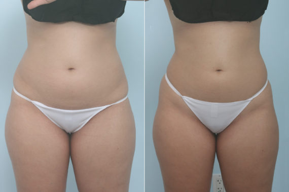 CoolSculpting Before and After Photos in Houston, TX, Patient 11357