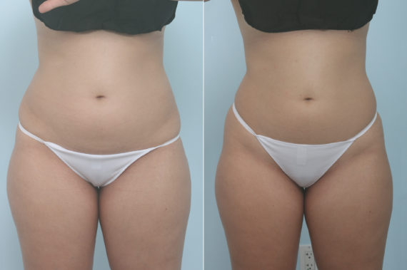 CoolSculpting vs. liposuction: Differences, effects, and more