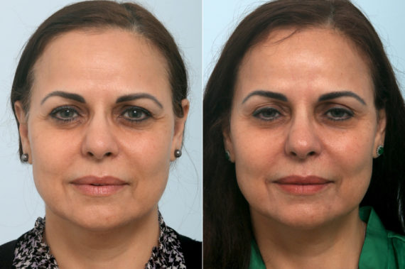 Ulthera Lift Before and After Photos in Houston, TX, Patient 11408