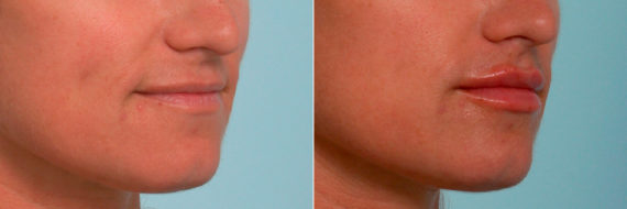 Lip Enhancement Before and After Photos in Houston, TX, Patient 11384