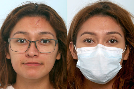 Fraxel Laser Before and After Photos in Houston, TX, Patient 11547