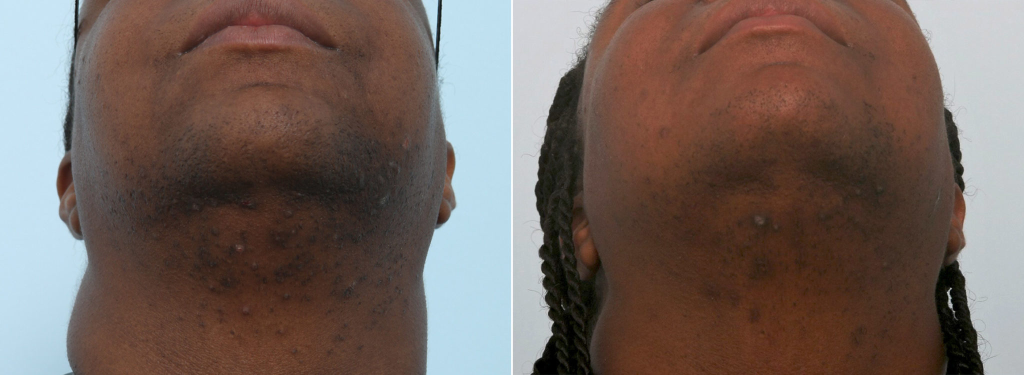 Laser Hair Removal Photos Houston, Tx Patient 8048