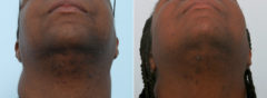 Laser Hair Removal Before and After Photos in Houston, TX, Patient 11565