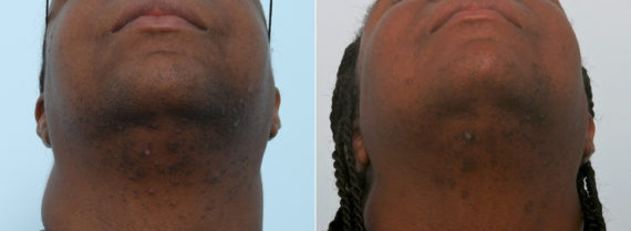 Laser Hair Removal Before and After Photos in Houston, TX, Patient 11565