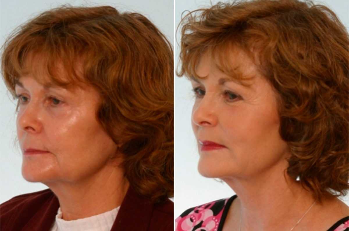 Juvederm Injectable Gel Before and After Photos in Houston, TX, Patient 8006