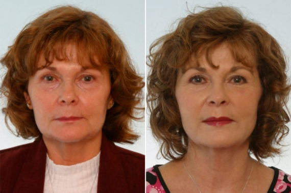 Juvederm Injectable Gel Before and After Photos in Houston, TX, Patient 8006