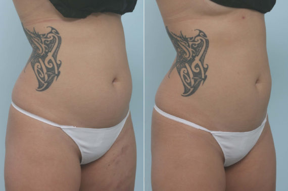 CoolSculpting Before and After Photos in Houston, TX, Patient 11717