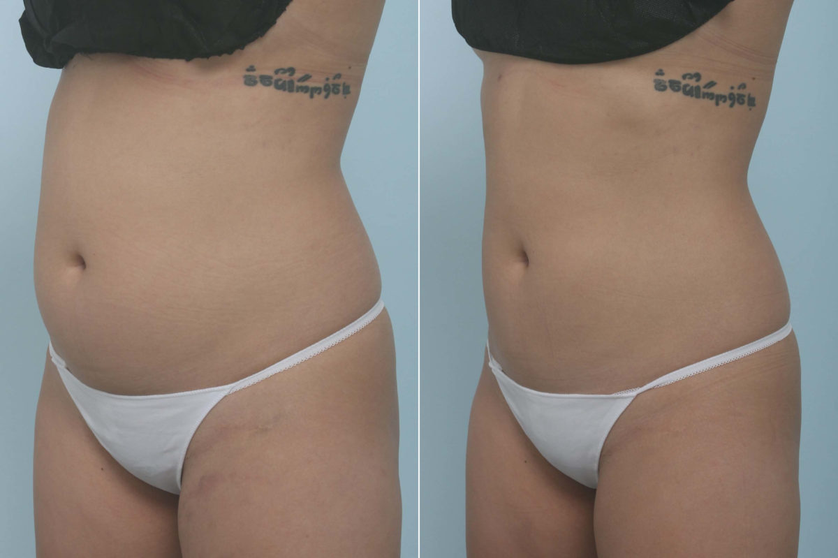 CoolSculpting Before and After Photos in Houston, TX, Patient 11717