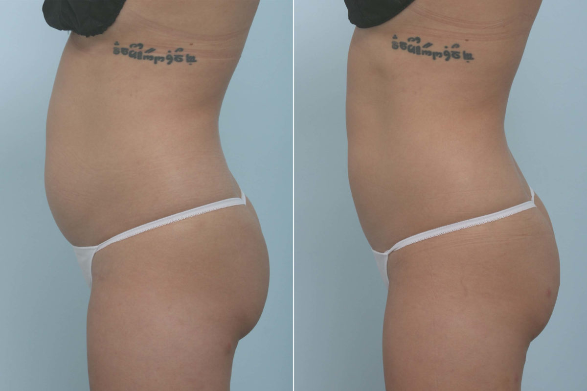 CoolSculpting Before and After Photos in Houston, TX, Patient 11717