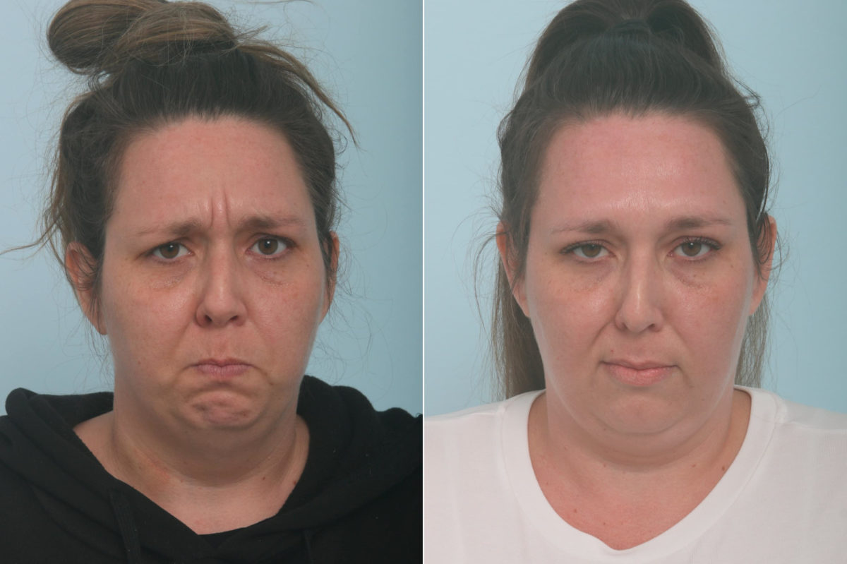 Botox® Cosmetic Before and After Photos in Houston, TX, Patient 11836