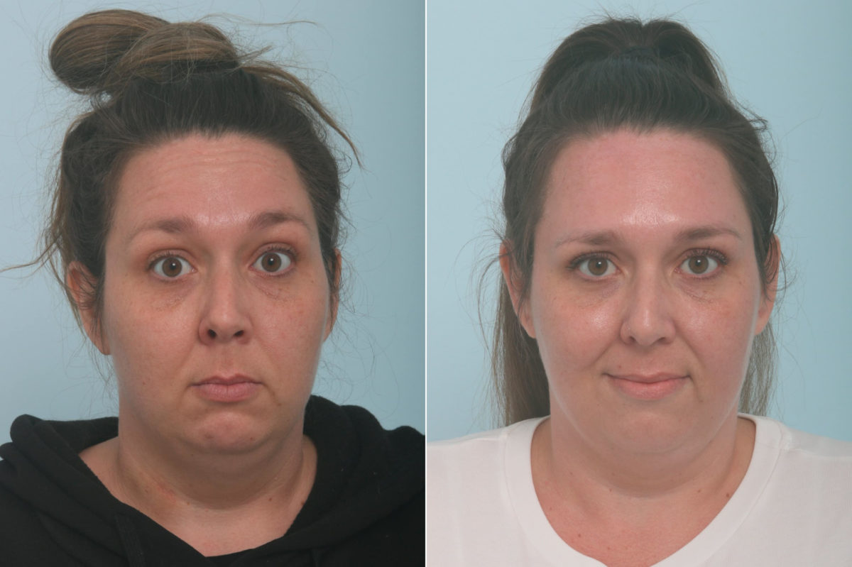 Botox® Cosmetic Before and After Photos in Houston, TX, Patient 11836