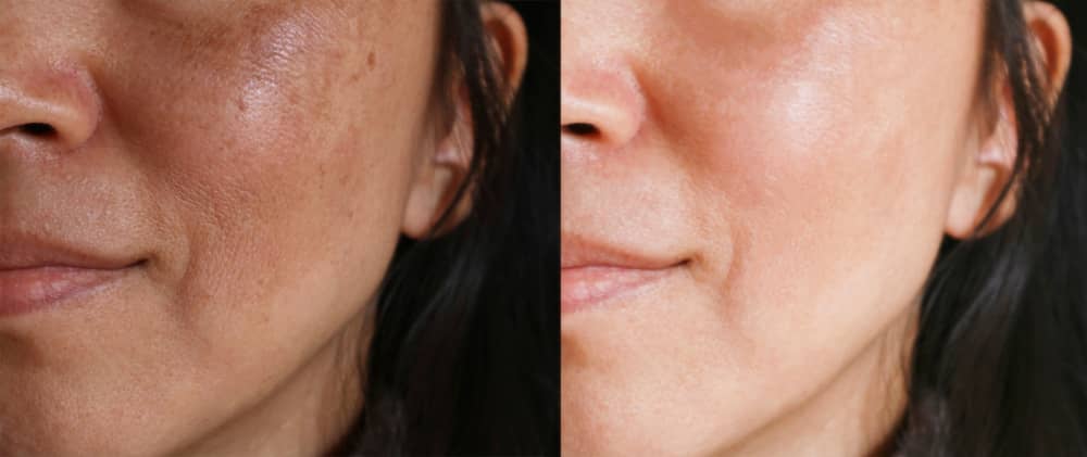 Brown spots, which are also known as “age spots,” “sun spots,” or “liver spots” are irregular spots or patches of dark pigmentation on the skin.