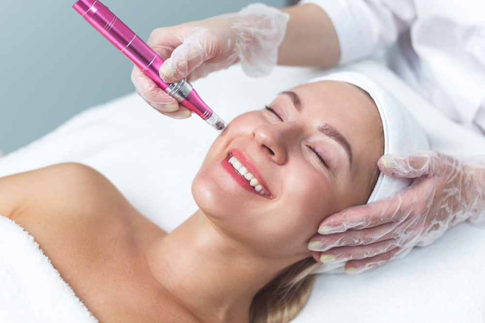 Microneedling can help minimize fine lines, wrinkles, and scars.