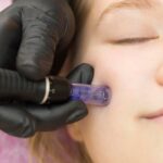 Skin Pen Microneedling: What You Need to Know