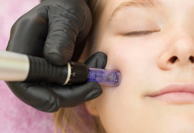 Close-up of microneedling treatment on facial skin to enhance rejuvenation.