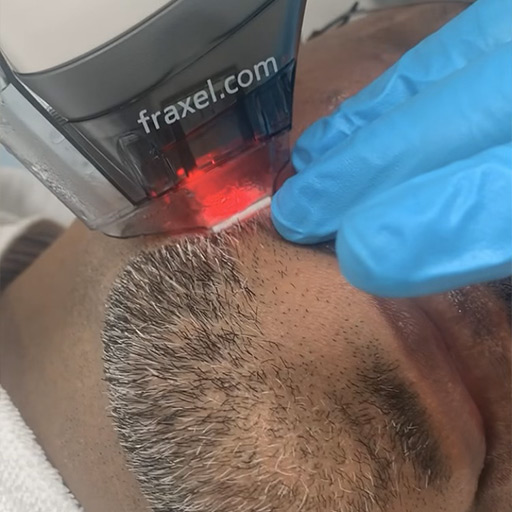 The Fraxel laser is uniquely designed to reduce the appearance of sun damage, hyperpigmentation, large pores, and scars