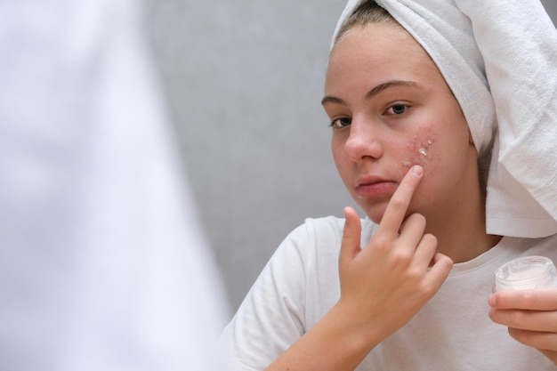 Effective acne treatment on skin