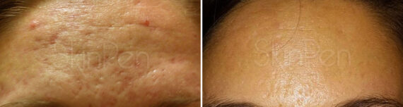 SkinPen® Microneedling Before and After Photos in Houston, TX, Patient 13705